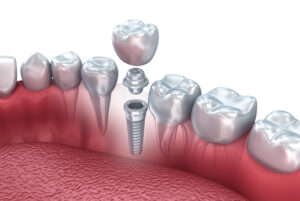 Tooth human implant, 3d illustration